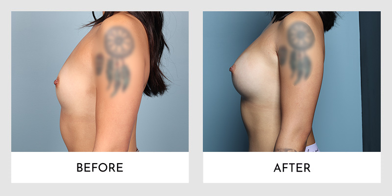 Scarless breast augmentation before and after side view highlighting no visible scars