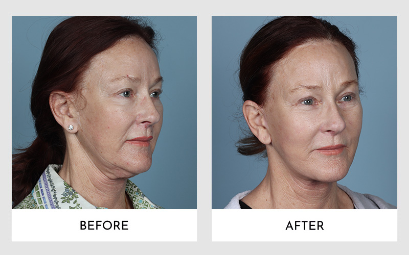 Side profile view of a patient before and after Secondary Facelift Surgery.