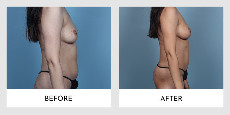  Before and after side angle photos showing Fat Transfer Breast Augmentation results, with enhanced curvature post-procedure.