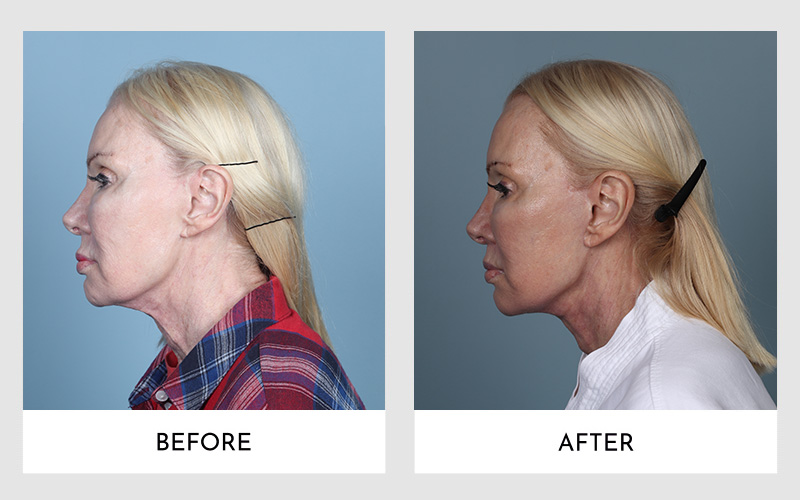  Side profile comparison of a woman before and after her Secondary Facelift Surgery.