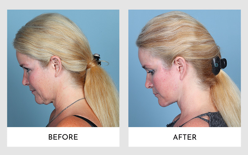 Side profile comparison of a blonde woman before and after a facelift.