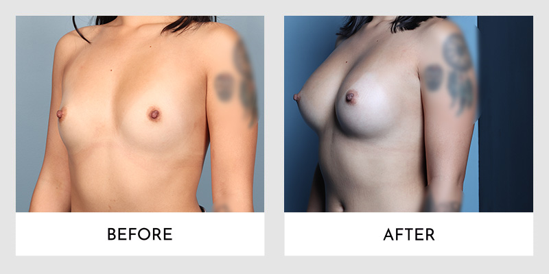 Side-by-side scarless breast augmentation results with no visible scarring
Title: Side View of Scarless Breast Augmentation Success