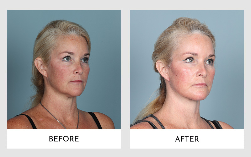 Three-quarter view facelift comparison of a blonde woman.