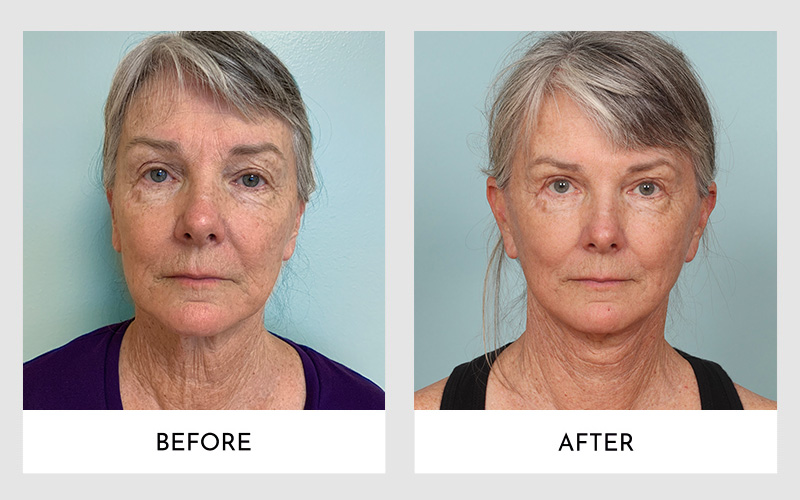 Before and after facelift comparison of a woman. Mini Facelift and Full Facelift