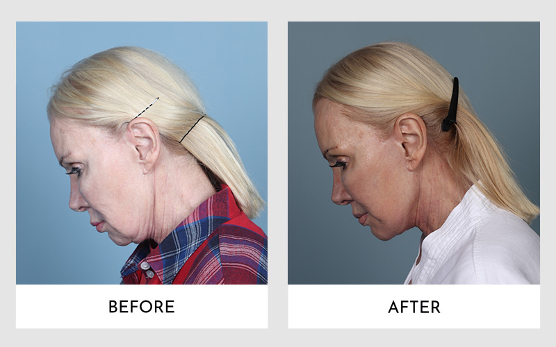 Woman's side profile before and post-Secondary Facelift Surgery, depicting rejuvenation.