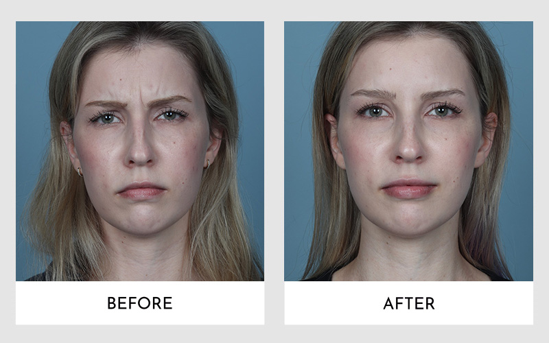 Before and after results of Botox treatment on a young woman