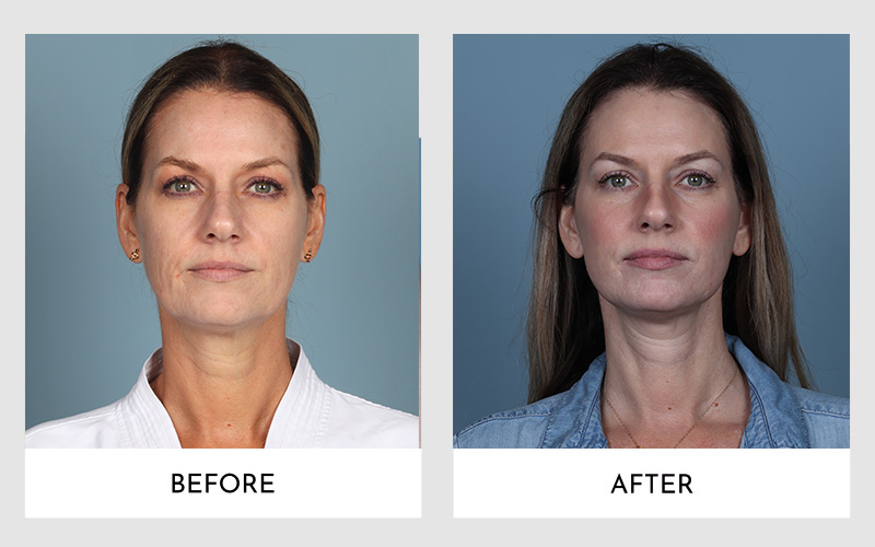 Before and after results of a Brow Lift procedure