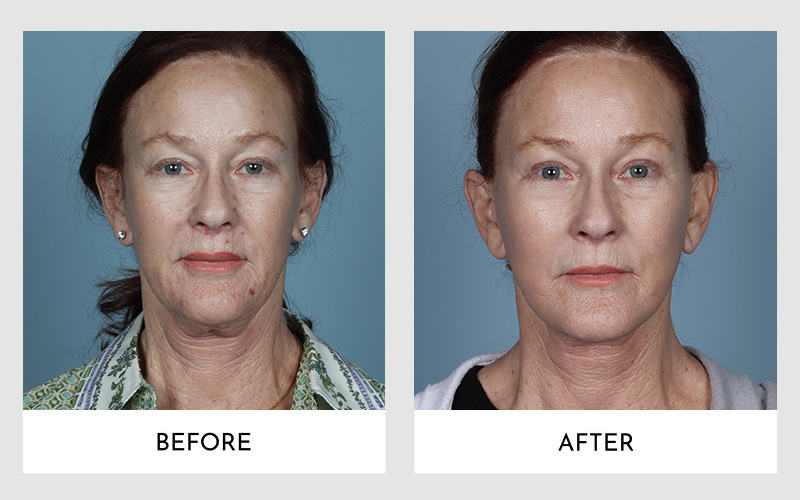 Facelift Revision Before and After Results