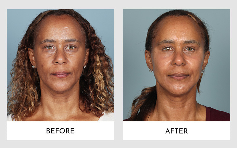Lower Blepharoplasty - Before and After Results