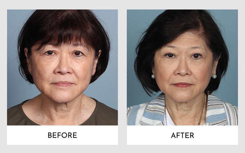 Upper Blepharoplasty Before and After