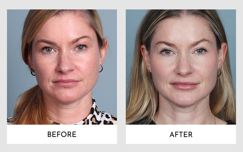 Upper Blepharoplasty