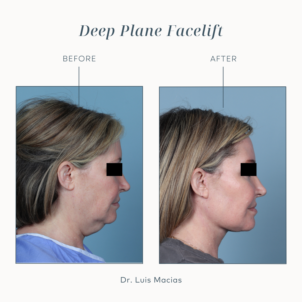Before and after comparison of a woman’s profile following a Deep Plane Facelift by Dr. Luis Macias.