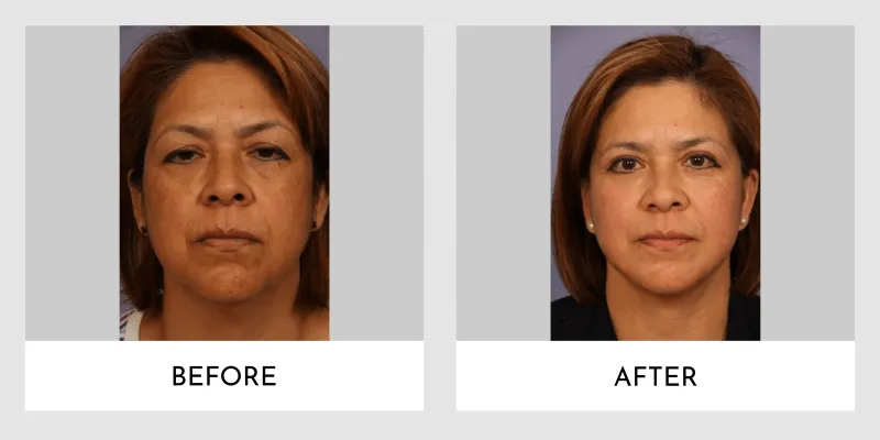 Before and after facelift transformation featuring a front-facing view of a woman. The "before" image shows visible signs of aging, including sagging skin and a tired expression, while the "after" image reveals a rejuvenated appearance with smoother skin, improved facial symmetry, and a refreshed look.