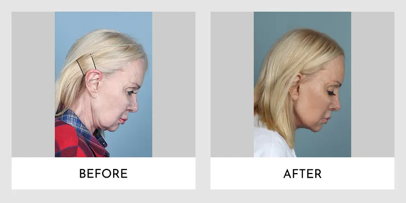 Before and after facelift transformation showing a woman's enhanced jawline, smoother neck, and overall rejuvenated appearance with tightened skin.