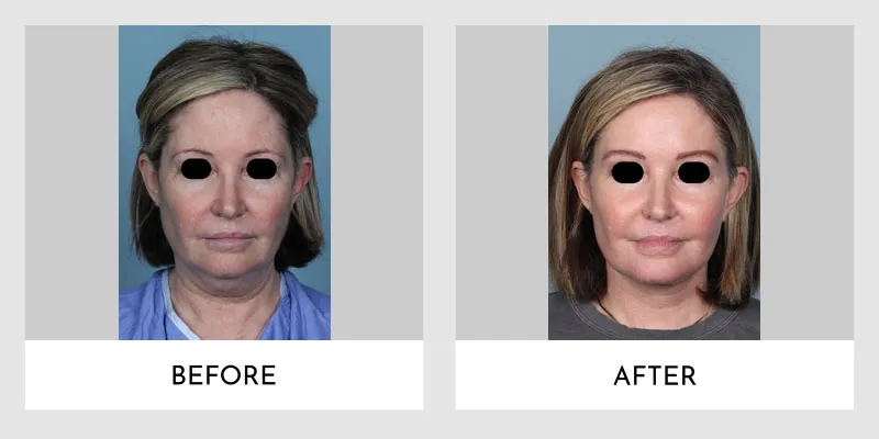  Before and after facelift transformation illustrating a woman's improved facial contour, tighter skin, and youthful rejuvenation.
