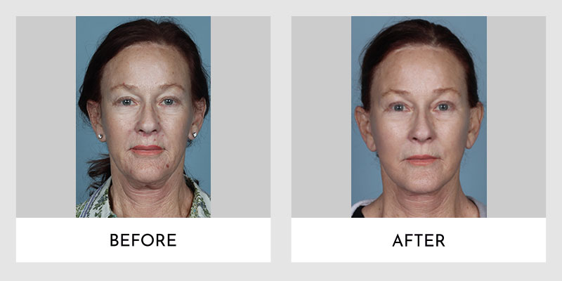 This image is showcasing a woman's rejuvenated appearance with smoother skin, reduced wrinkles, and a more youthful facial contour.