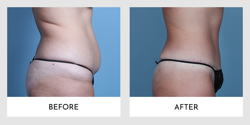 Before and after tummy tuck profile view showing a significant reduction in abdominal bulge and enhanced waistline contour.
