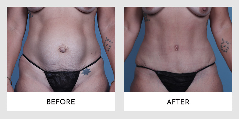 Before and after tummy tuck showing a smoother, flatter abdomen with excess skin and loose tissue removed, revealing a more toned and contoured midsection.