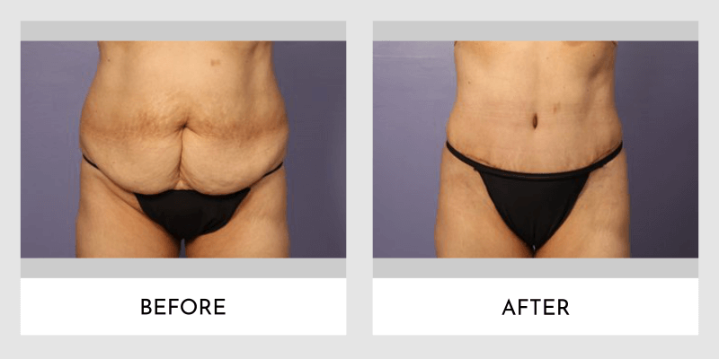 Before and after tummy tuck showing the removal of loose, hanging abdominal skin and a firmer, flatter midsection with visible muscle definition.