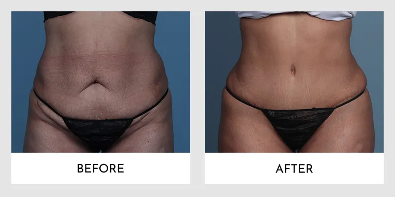 Before and after tummy tuck results showing a dramatic transformation in abdominal contour, with excess skin and sagging visibly reduced and a firmer, flatter stomach achieved.