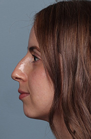 chin5