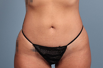 lipo6