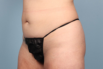 lipo7
