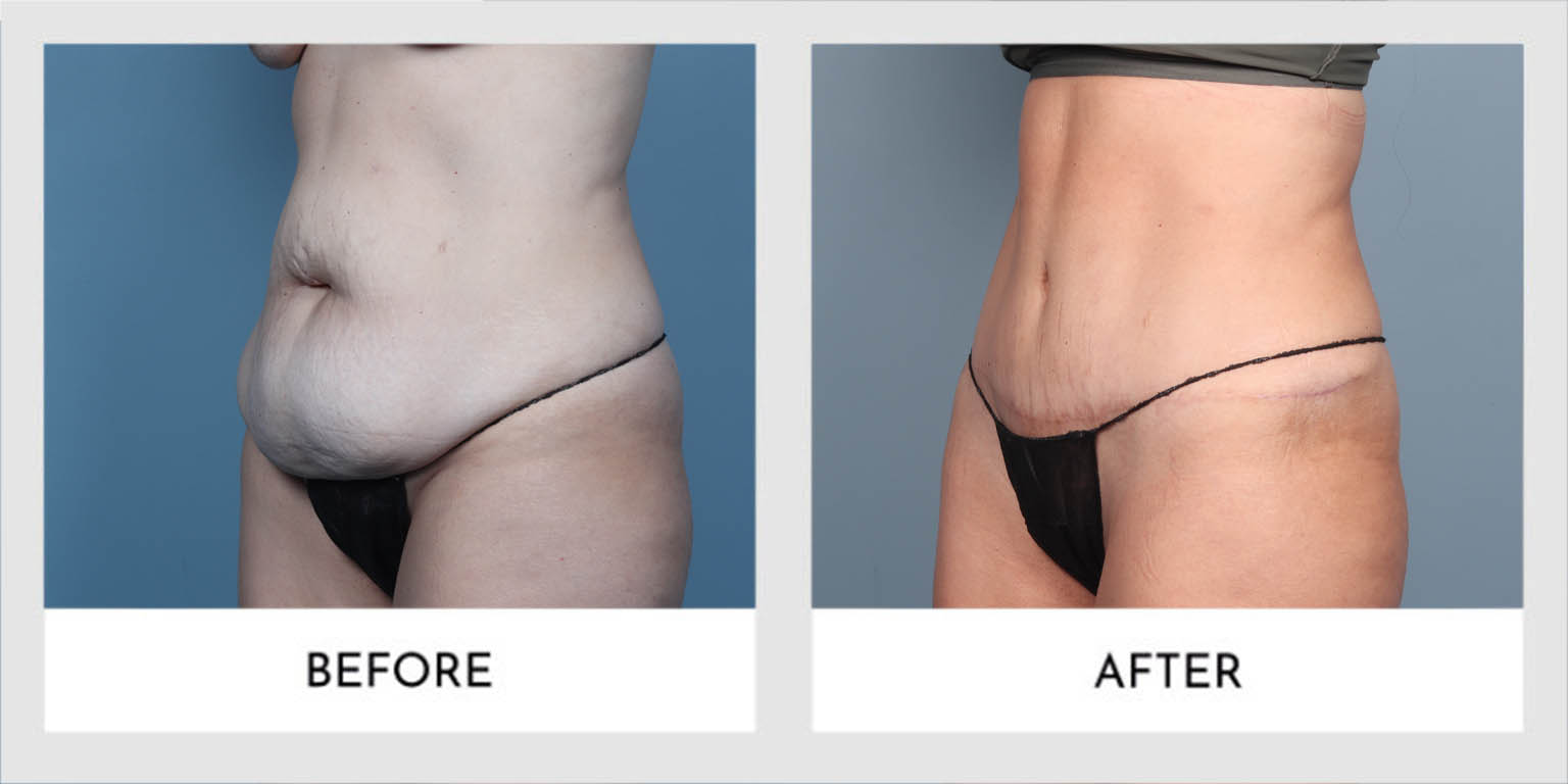 tummy tuck
