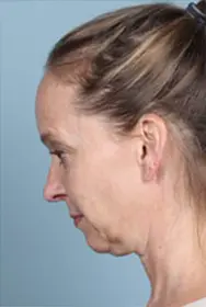 necklift-ba-1b