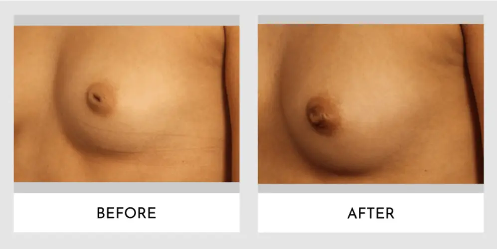 patient-spotlight-inv-nipple